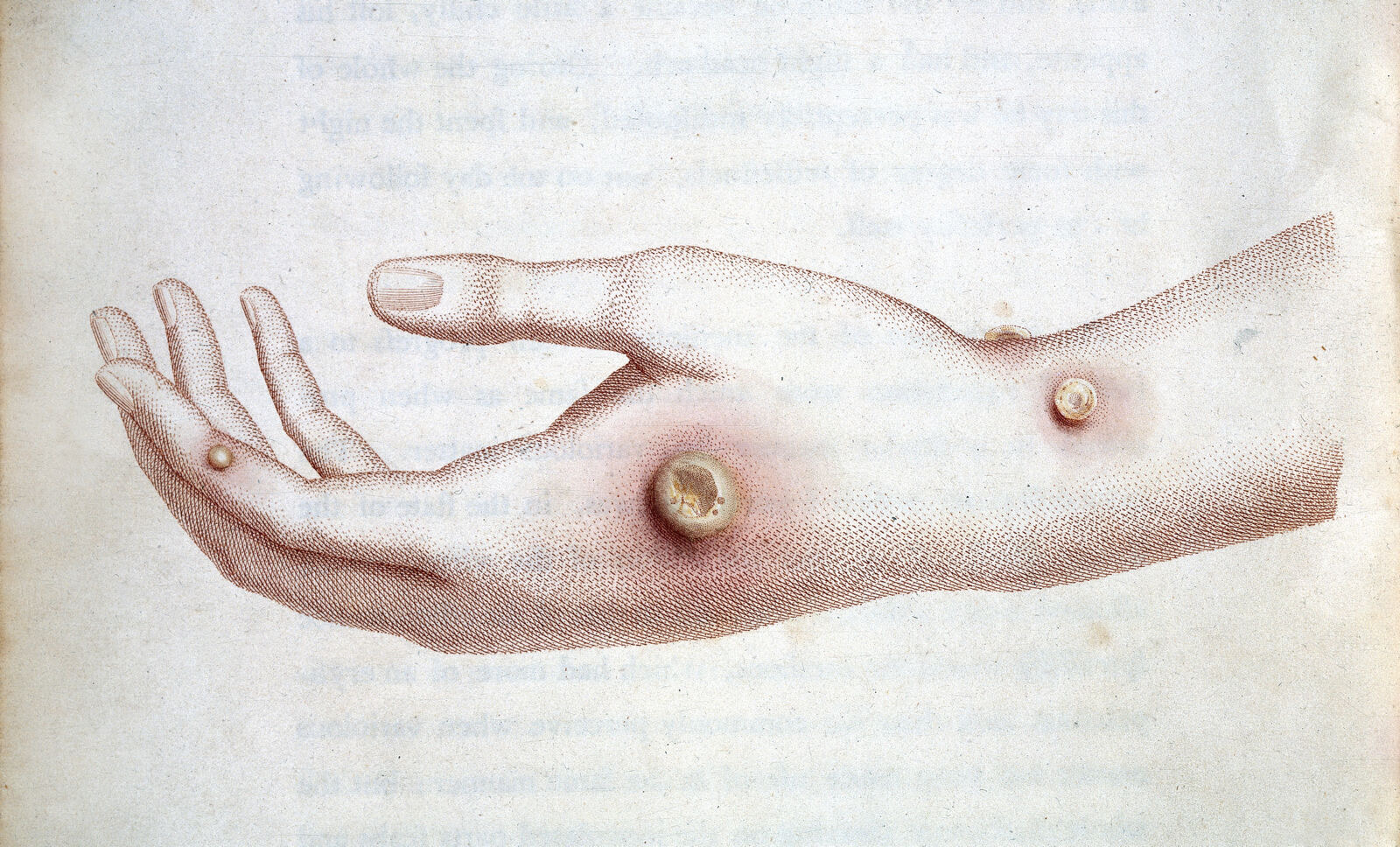 A coloured stipple engraving of a woman's right hand and forearm, palm up, with a large round pustule at the base of the thumb and two smaller ones on the wrist