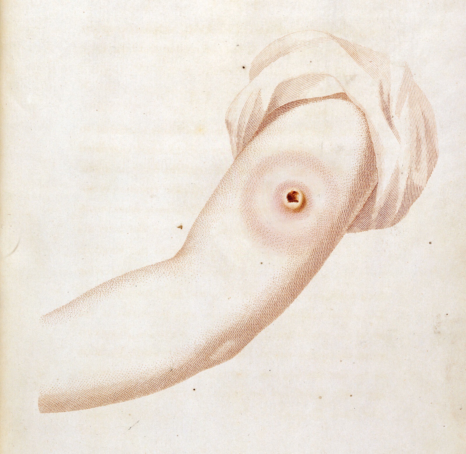 A coloured stipple engraving of a child's upper arm with the sleeve pushed up, showing a single dark-centred pustule surrounded by a wide pink ring